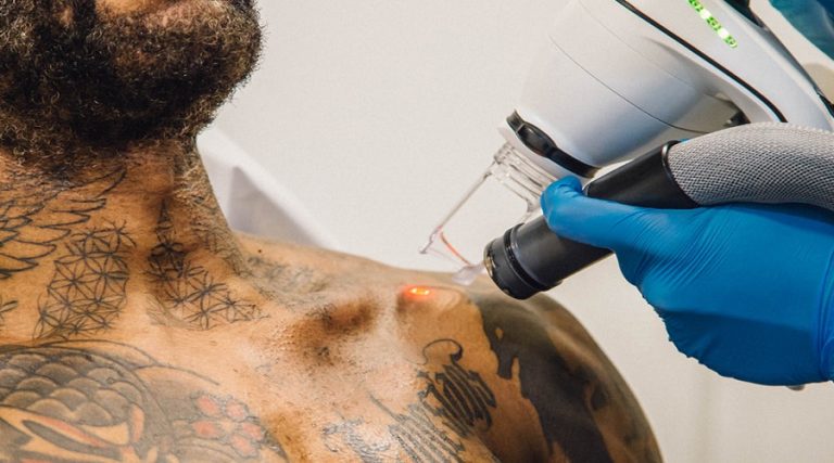 How Much Does Tattoo Removal Hurt